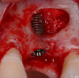 Sinus floor elevation